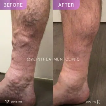 Spider and Varicose Vein Treatment Center media 1